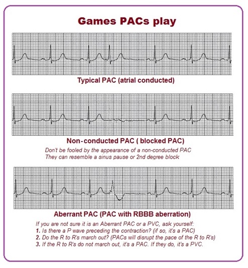 Premature Atrial Contraction Strip