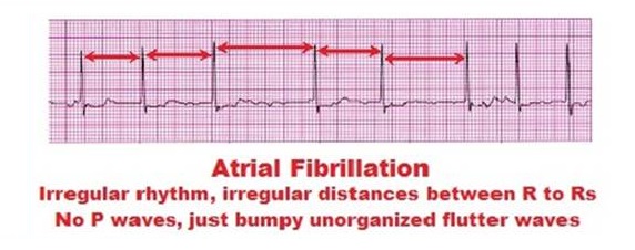 Ekg Strip Search