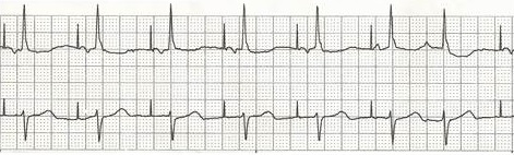 Single chamber pacemaker ecg