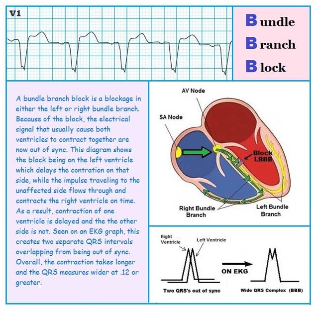 Bundle Branch Block (BBB)