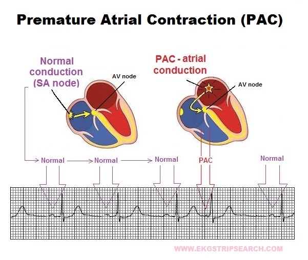 Premature Atrial Contractions Pacs Ecg Review Criteri - vrogue.co