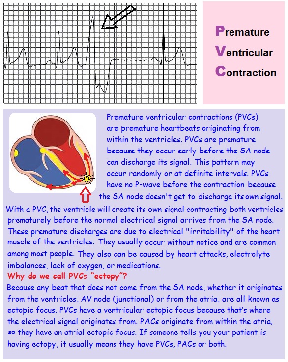 See different examples of PVCs below