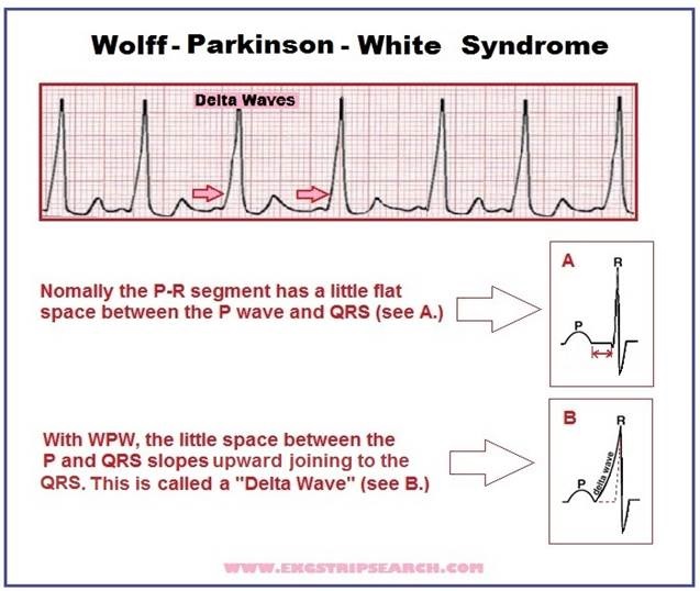 Ecg Wolff Parkinson White Syndrome Ekg